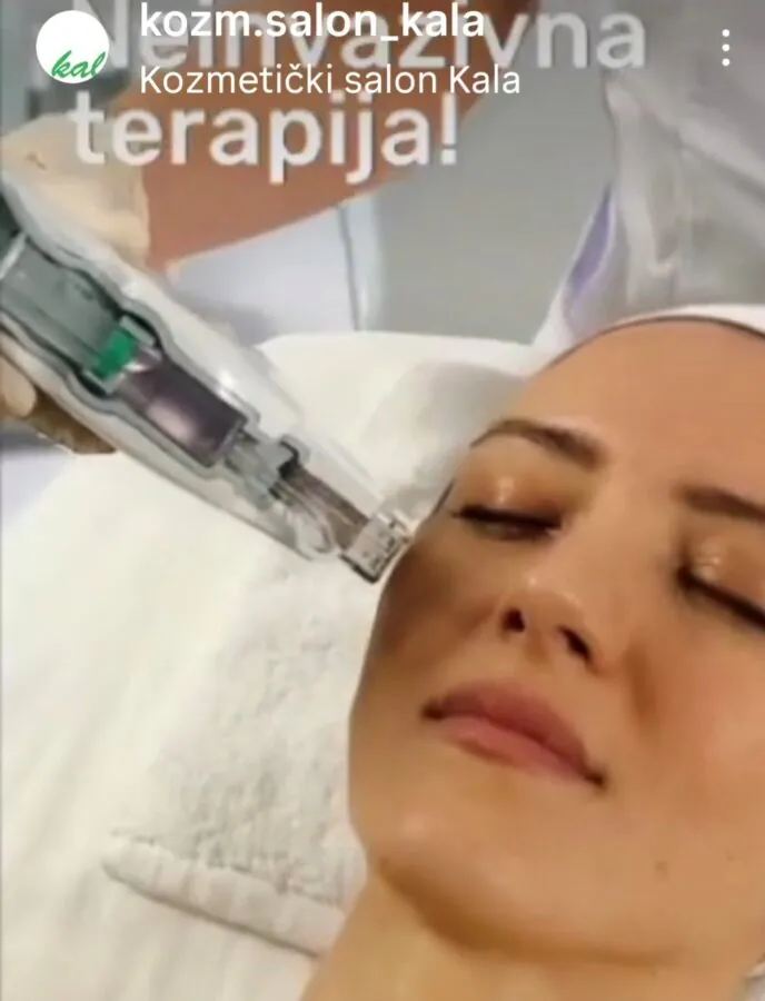 Mesoject Gun (Mezoterapija bez igala) - Kala 