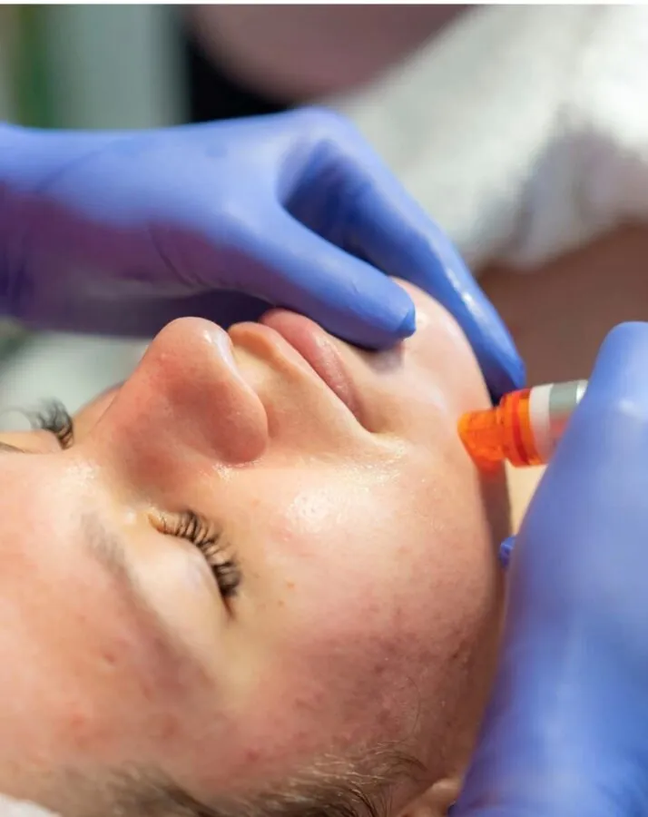Hydrafacial (Dubinski sjaj i eksfolijacija) - Kala 
