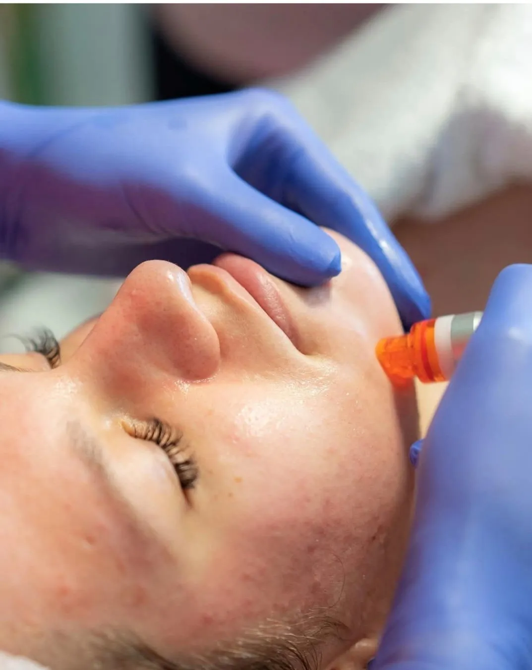 Hydrafacial (Dubinski sjaj i eksfolijacija) - Kala 